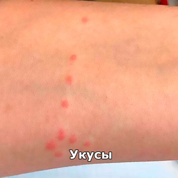 укусы